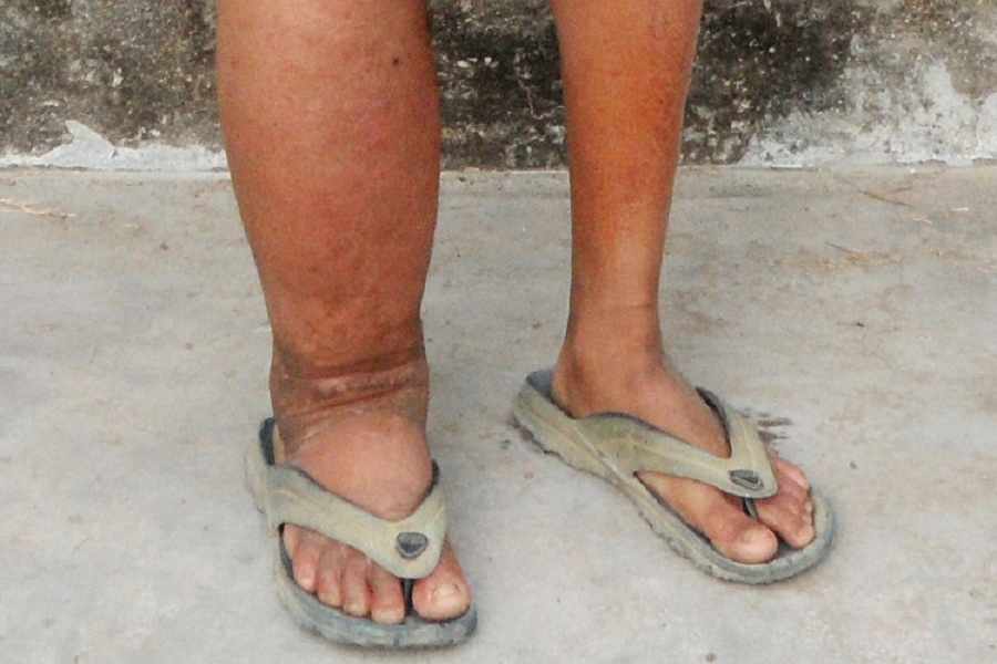 हात्तीपाइले रोगविरुद्धको औषधि १२ जिल्लामा खुवाइने