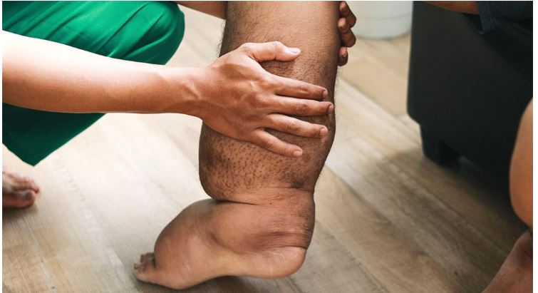 आइतबारदेखि हात्तीपाइले रोगविरुद्ध औषधि खुवाइने