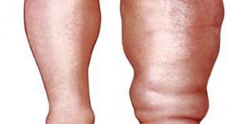 धनुषामा नौ सय जनामा हात्तीपाइले रोग