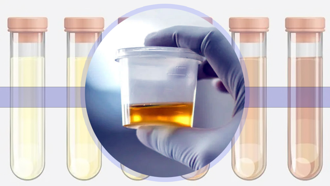 पिसाबको रङले तपाईँको शरीरबारे के बताउँछ र कस्तो बेलामा चिन्ता गर्ने ?