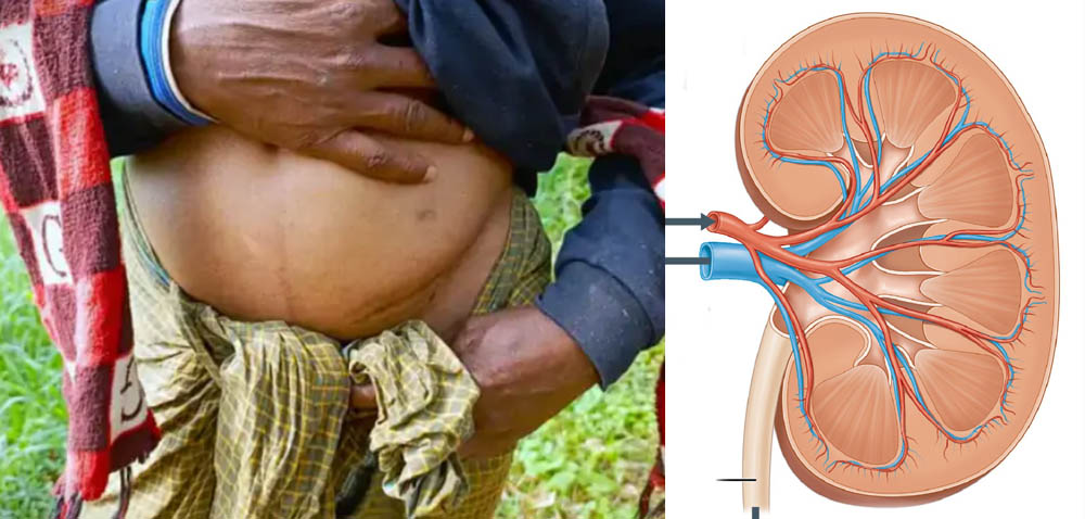 भारतमा मिर्गौला बेच्दै बङ्गलादेशी !
