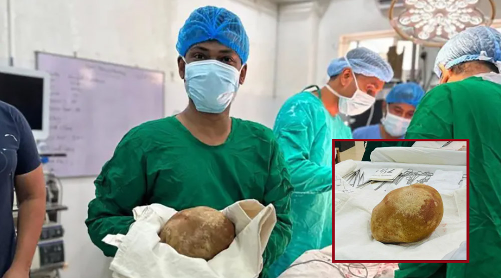 बिरामीको मूत्रथैलीबाट ३.१ किलोको पथरी निकालियो